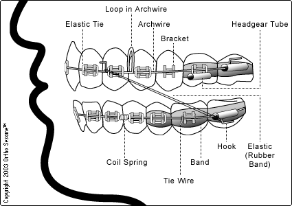 Parts of Your Braces